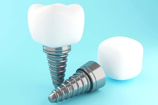 Dental Implant